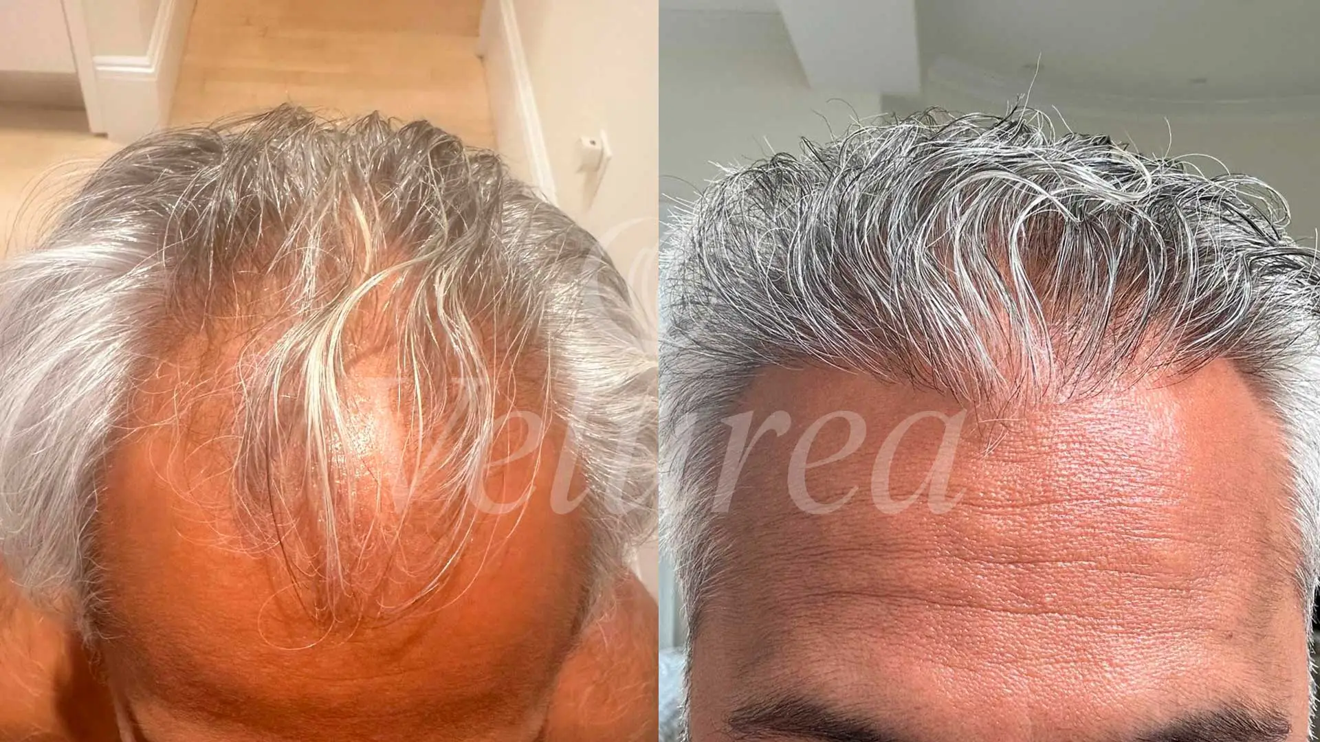 after-and-before-hair-transplant-velurea