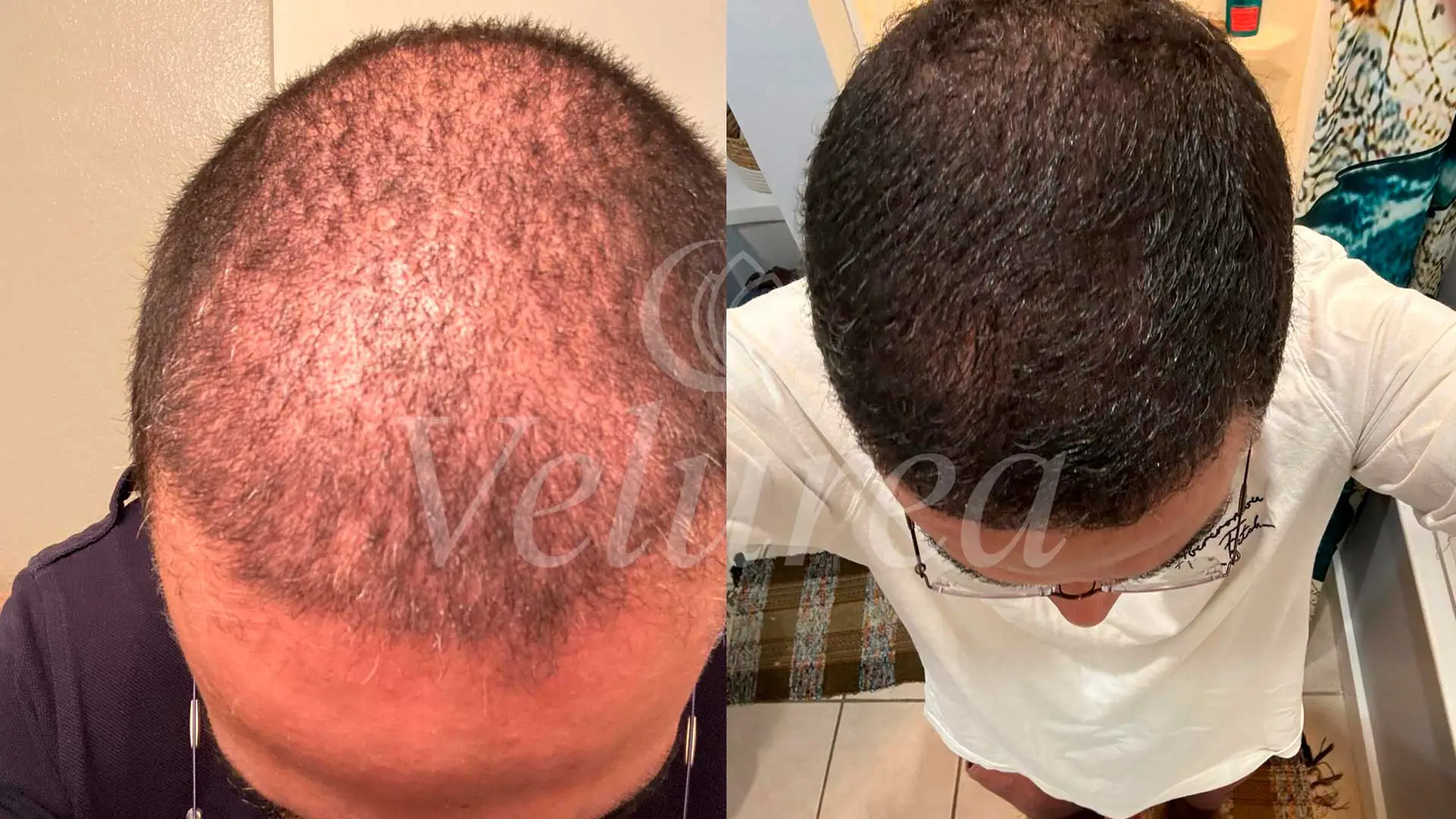 hair-transplant-before-and-after
