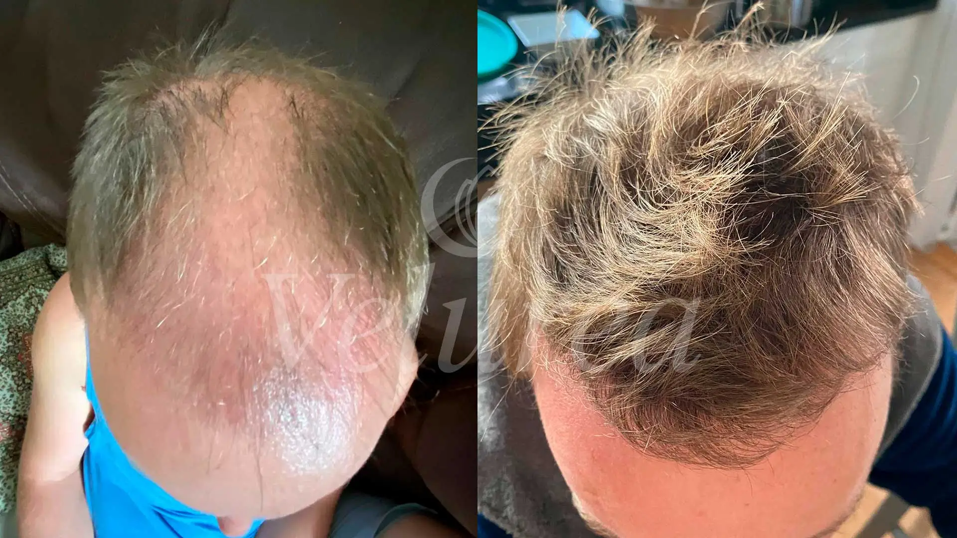 hair transplante-before and after velurea