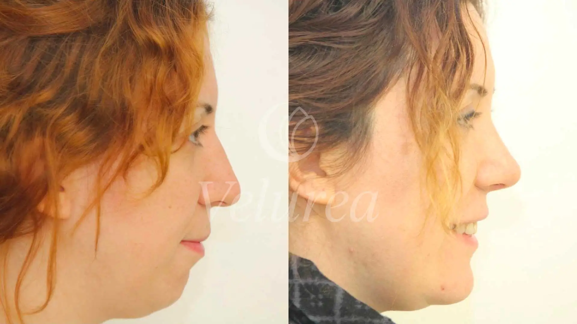 rhinoplasty results woman