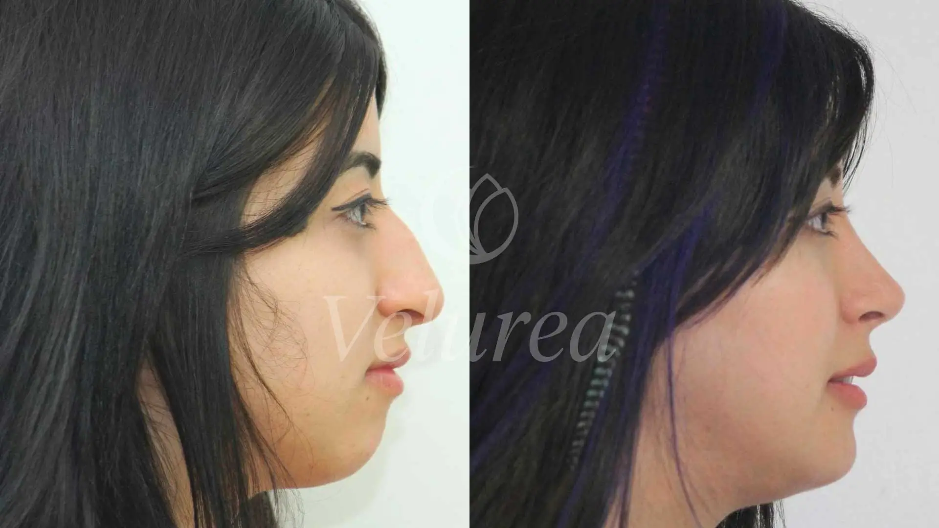 rhinoplasty results woman